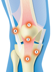 膝の痛み　種類