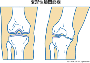 変形性膝関節症　症状
